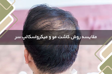 مقایسه روش کاشت مو و میکرواسکالپ سر
