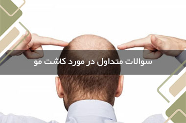 سوالات متداول در مورد کاشت مو