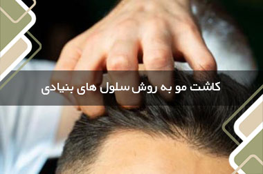 کاشت مو به روش سلول های بنیادی