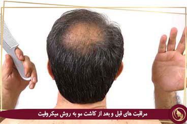مراقبت های قبل و بعد از کاشت مو به روش میکروفیت 