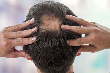 تاثیر DHT بر ریزش مو چیست؟
