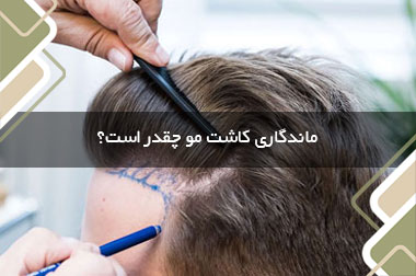 ماندگاری کاشت مو چقدر است؟
