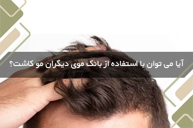 آیا می توان با استفاده از بانک موی دیگران مو کاشت؟