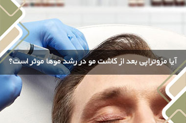 آیا مزوتراپی بعد از کاشت مو در رشد موها موثر است؟