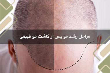 مراحل رشد مو پس از کاشت مو طبیعی