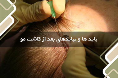 باید ها و نبایدهای بعد از کاشت مو