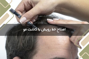 اصلاح خط رویش با کاشت مو