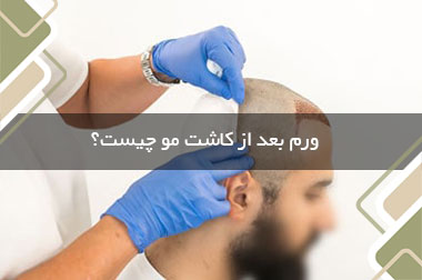 ورم بعد از کاشت مو چیست و چگونه درمان می شود؟